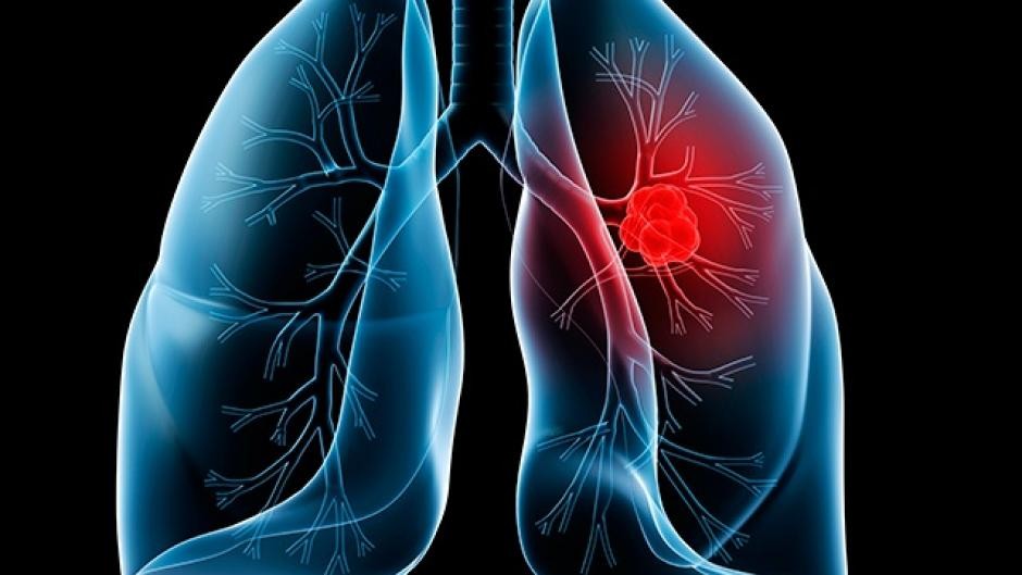 Bệnh u phổi là gì